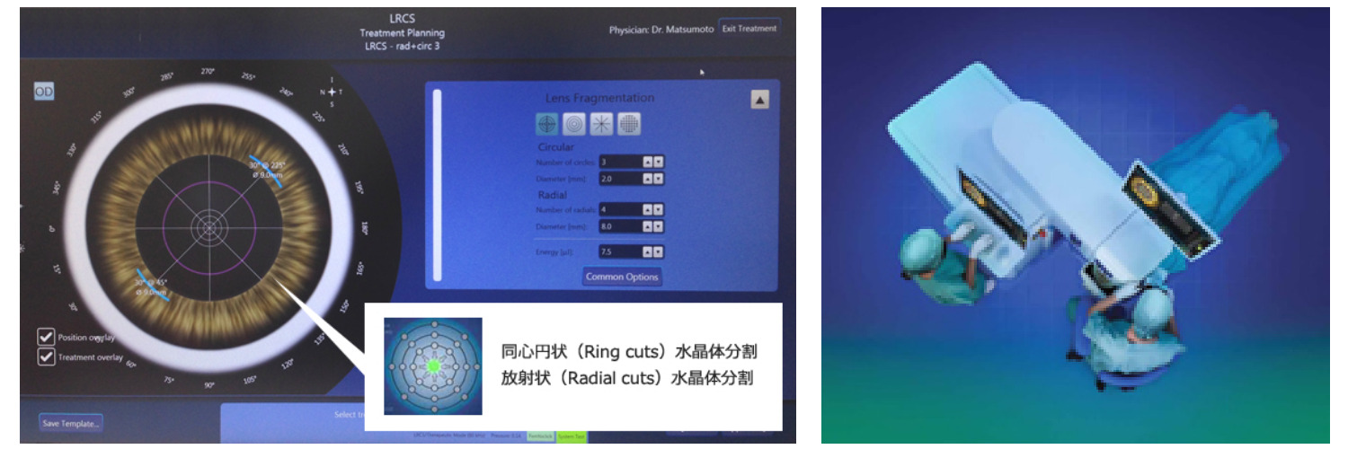 レーザー白内障手術やレーシックにおける「フラップの形成」で最も高い評価を得ています