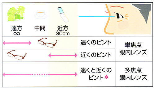 眼内レンズ挿入後のピントについて