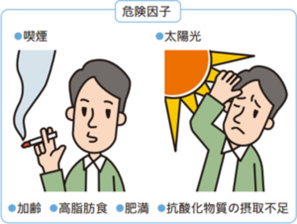 加齢黄斑変性の原因