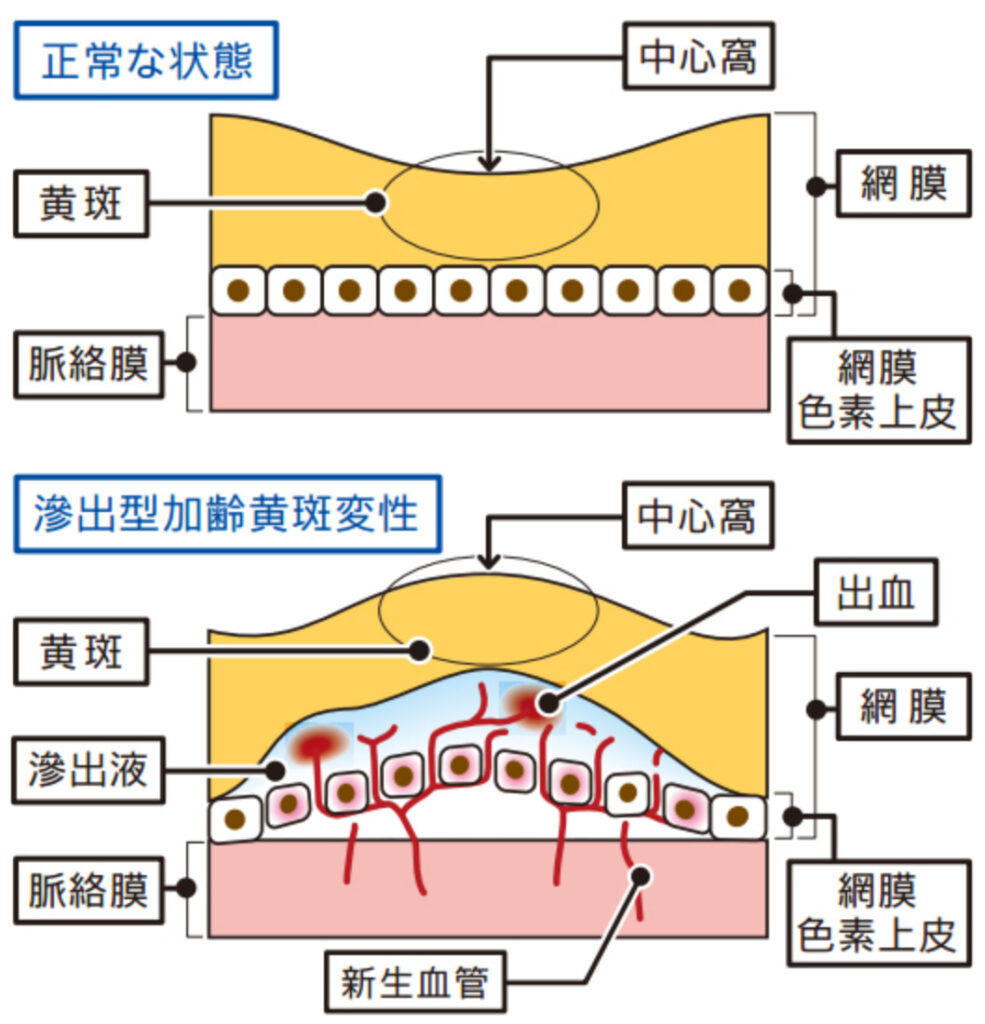 滲出型加齢黄斑変性の構造
