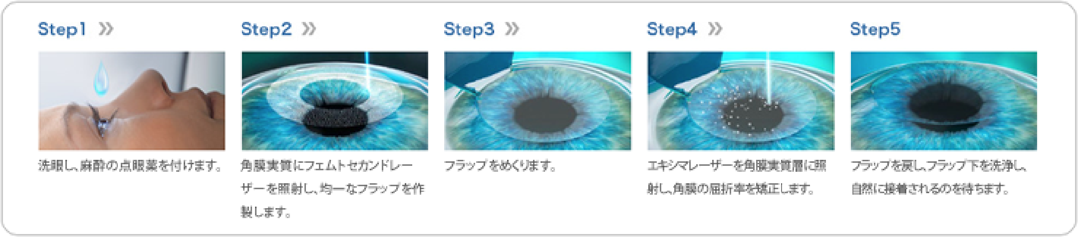 レーシック