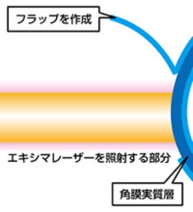 角膜実質層は、角膜断面5層のうちの真中にあり、もっとも厚い層です。